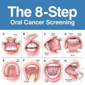 Ο έλεγχος για τον καρκίνο του στόματος γίνεται πριν εμφανιστούν συμπτώματα. Όταν εμφανίζονται, ο καρκίνος μπορεί να έχει αρχίσει ήδη να εξαπλώνεται.