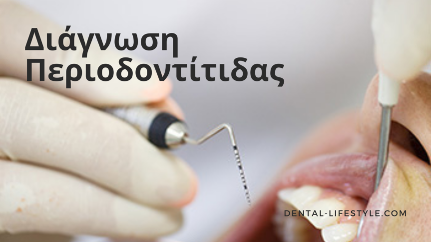 Η περιοδοντίτιδα, αποτελεί το πιο σύνηθες αίτιο απώλειας δοντιών στους ενήλικες.