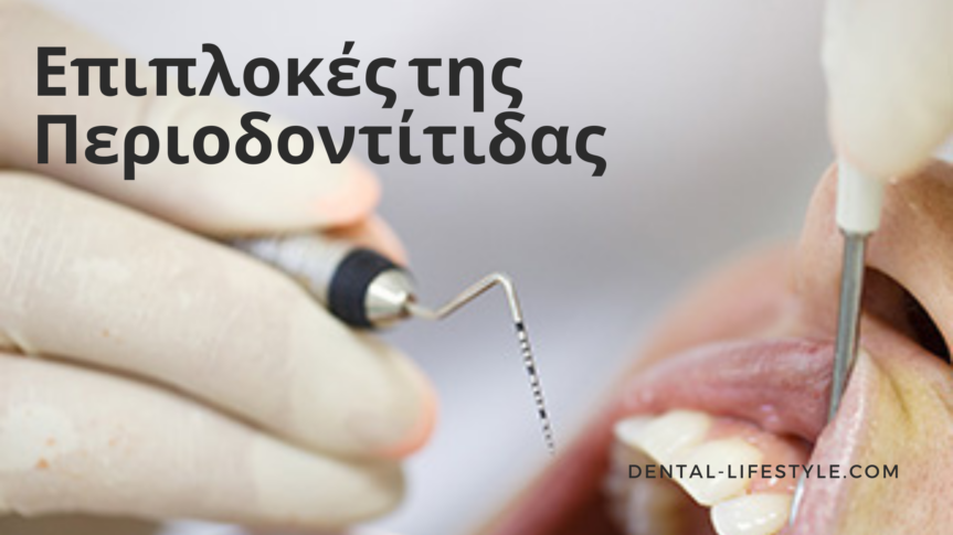 Η πιο προφανής έκβαση της περιοδοντίτιδας είναι η απώλεια των δοντιών, αλλά υπάρχουν και άλλες επιπλοκές που μπορούν να προκαλέσουν σοβαρά προβλήματα υγείας.