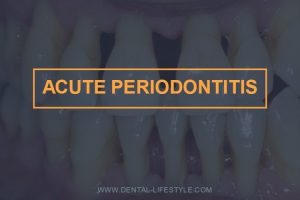 Periodontitis is an inflammatory process,it's characterized by breakdown of periodontal fibre bundles at the cervical margin ,resorption