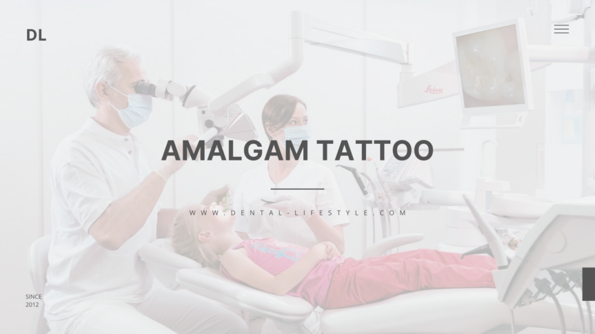 You or your dentist may notice a gray, blue or black spot in your mouth that looks like a tattoo. Dentists call these spots amalgam tattoos.