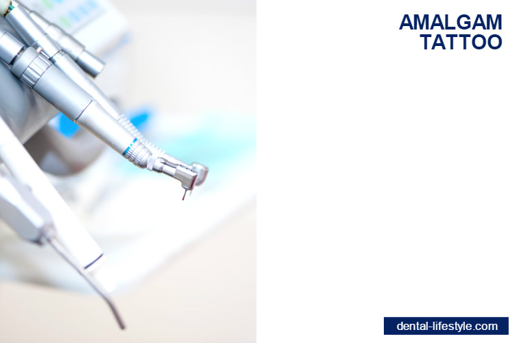 Amalgam tattoo | oral health tips and tricks | dental-lifestyle