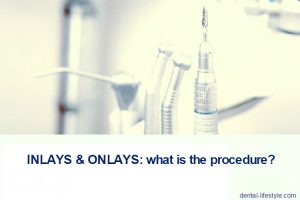The inlays and onlays are not directly made in the patient's mouth like fillings but they should be made in the dental laboratory. For this reason, the installation requires at least two visits to the dentist.