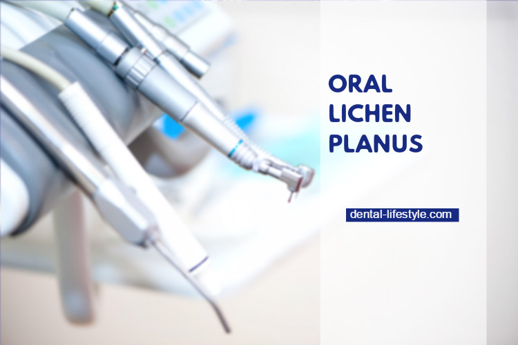 Oral lichen planus is an ongoing (chronic) inflammatory condition that affects mucous membranes inside your mouth.