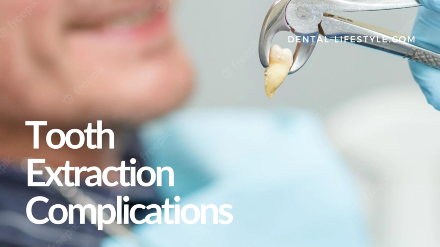 In the list that follows you can review some of the most common complications that can follow tooth extraction.