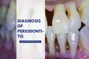 Periodontitis and its diagnosis, keep on reading to learn all about it! How dan your dentist diagnose it? What is he looking for?
