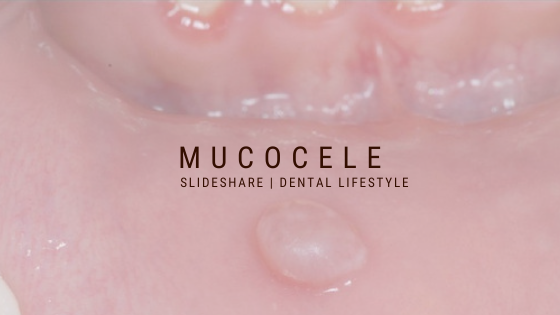 What is a mucocele? Why and how does it appear? What are the signs and symptoms? Is there treatment available? Is it a dangerous condition?