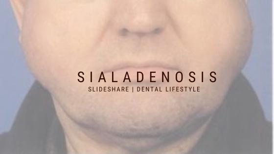 Sialoadenosis (sialosis)