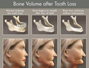 What happens to your bone after you lost a tooth? Does it stay exactly the same or are there any changes ? Learn all you need to know!