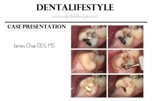 This case belongs to Dr James Chae DDS, MS. Keep on reading to find out the details behind the treatment as described from the doctor himself.