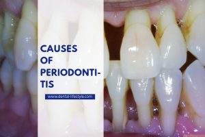 It's thought that periodontitis begins with plaque — a sticky film composed mainly of bacteria. Plaque forms on your teeth when starches and sugars in food interact with bacteria normally found in your mouth.
