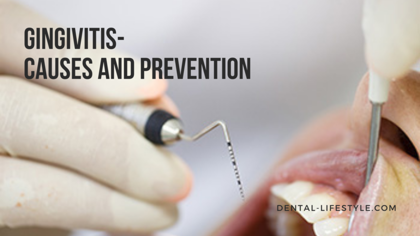 Gingivitis is a pathological condition of the gums which is characterized by inflammation and bleeding.