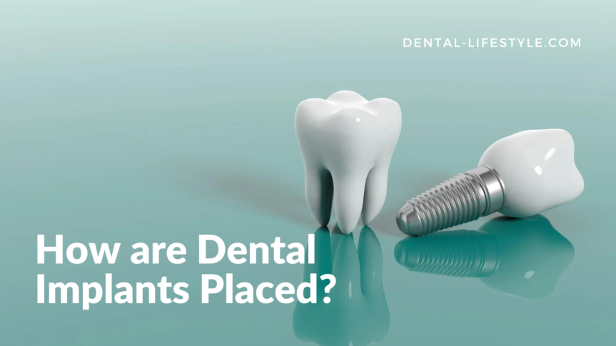 How are Dental Implants Placed?