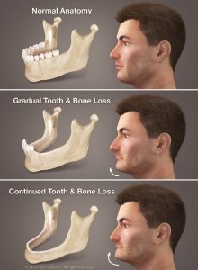 Do jawbones shrink?Yes, indeed, jawbones can shrink over time.There are factors that contribute to bone loss.