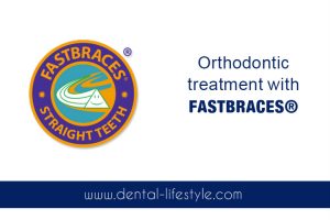 What is our goal by working with FASTBRACES ® system? What are the benefits of this system? Take a read in this article and find out all about it !