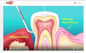 Take a look at this short video with animation. Showing you what happens to your mouth when you suffer from periodontal disease. You can see exactly which areas it affects. And also how your dentists can help you get rid of it!