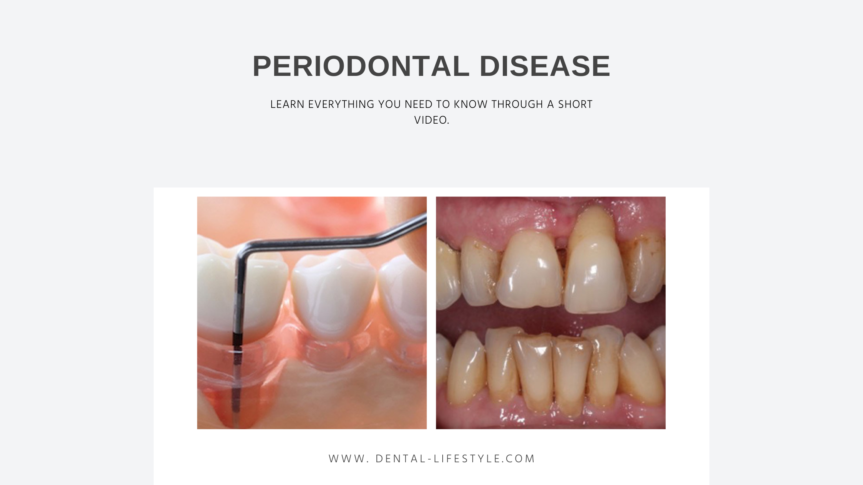 Take a look at this short video with animation. Showing to you exactly what happens when you suffer from periodontal disease.