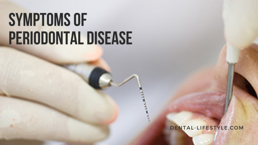 Gum disease may progress painlessly, producing few obvious signs, even in the late stages of the disease.