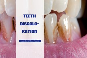 What is teeth discoloration?why and when does it occur? Take a look at the short video that follows and find all your answers !