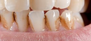 What is teeth discoloration?why and when does it occur? Take a look at the short video that follows and find all your answers !