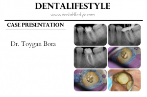 This endodontic case belongs to Dr. Toygan Bora.You can see the root canal treatment process with close-up photos.Take a look and find out the details.