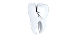 Το σπάσιμο των δοντιών δεν είναι τόσο ασυνήθιστο.Όπως τα οστά στο υπόλοιπο σώμα σας μπορεί να σπάσουν ή να τραυματιστούν, έτσι και τα δόντια σας.