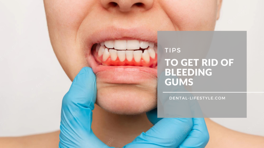 Tips to Get Rid of Bleeding Gums