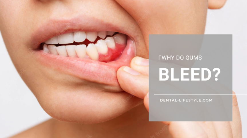 Why do gums bleed? This is a very common question. The answer is not so simple though. There is not just one single reason why your gums bleed.