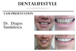 Today we present you a case by Dr. Dragos Sandulescu. As in every presentation of ours, you can see pictures before & after the treatment. You can also read the description down below for more details!