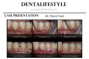 In this post, we present a periodontal case which belongs to Dr. Sherif Said. You can read the description below to learn how he treated this particular patient.