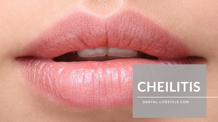 Cheilitis is an abnormal condition of the lips characterized by inflammation and cracking of the skin. There are several forms, including those caused by excessive exposure to sunlight, allergic sensitivity to cosmetics, and vitamin deficiency.