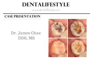 This case belongs to Dr. James Chae DDS, MS. Keep on reading to find out the details of the treatment, described by the doctor himself.