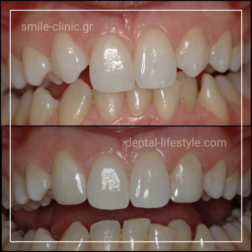 Η μέθοδος Bonding είναι η τοποθέτηση σύνθετης ρητίνης στα δόντια, με σκοπό την αισθητική βελτίωσή τους. Το υλικό που τοποθετείται μπορεί να καλύπτει ολόκληρη την επιφάνεια του δοντιού που τροποποιείται (όψη ρητίνης), ή να καλύπτει μέρος αυτής.