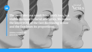 The most obvious result from tooth loss, is a visible decrease in facial aesthetics. We notice the lower third of the face decreasing in size and the face loses its proportions.